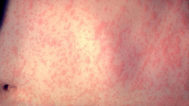 measles-symptoms-measles-symptoms-diagnosis-and-treatments