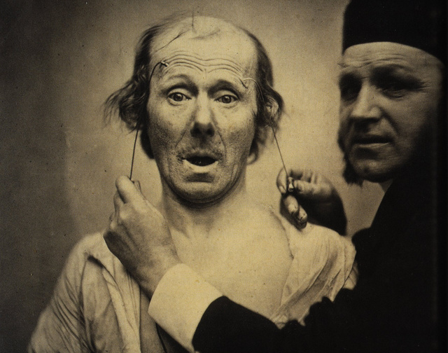 Guillaume Duchenne de Boulogne performing facial electrostimulus