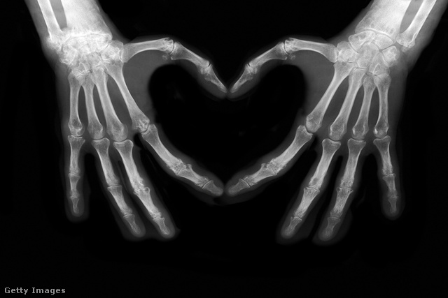 A csontritkulás tünetei először általában a kéz csontjaiban jelentkeznek