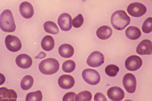 A vérszegénység esetén a hemoglobin és a vörösvérsejtek mennyisége jóval a normális érték alá süllyed