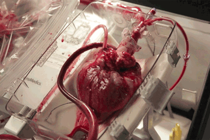 Heart transplant boxx519.gif