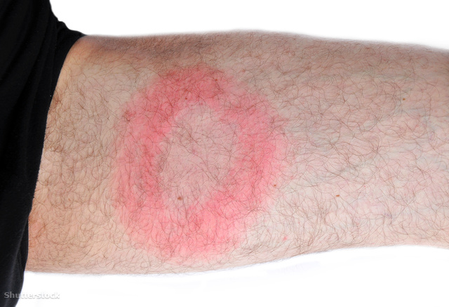 A Lyme-kór tüneteként a csípés köröl megjelenő jellegzetes piros kör