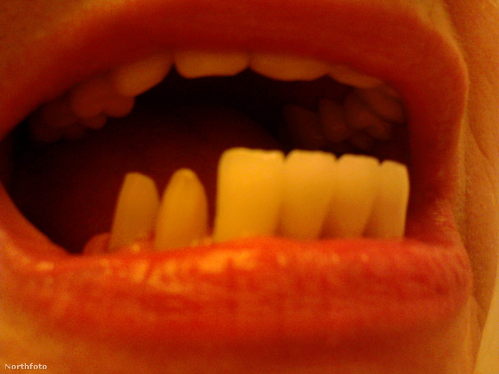 Egy fotó a nő beültetett fogairól, amik szerinte sokkal nagyobbak, mint az eredeti fogai, és előre is dőlnek a szájában.
