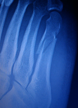 Steiner lábáról készült röntgenfelvétel
