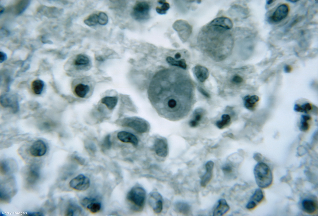 Így néznek ki a Naegleria fowlerivel fertőzött agysejtek