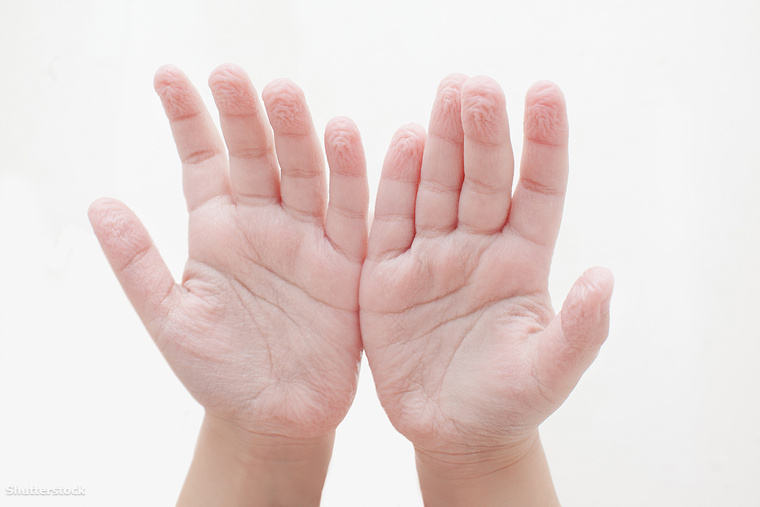 Súlyos betegségeket jelezhet a kézfejed: 9 árulkodó tünet, hogy baj van - HelloVidék