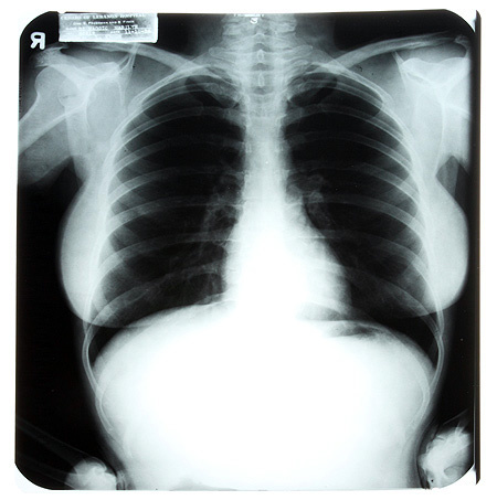 Az egyik elhíresült röntgenkép