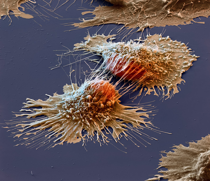 Az elektronmikroszkóp segítségével készített, megrázó hatású képen rákos sejtek látszanak.