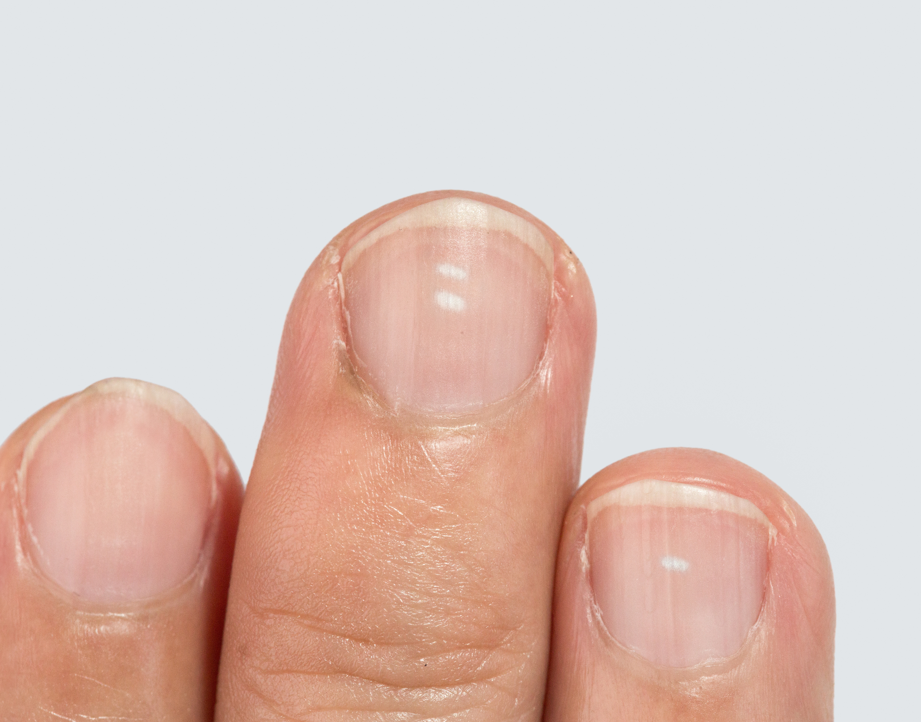 nail gomba underotherapy mit jelent a legjobbat a köröm gomba