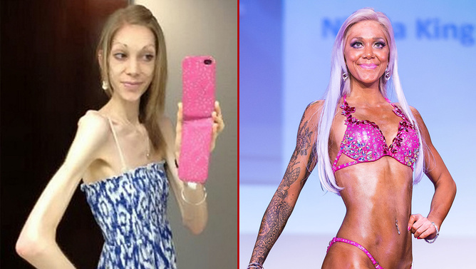 Anorexiás volt, most tökéletes külsejű testépítő