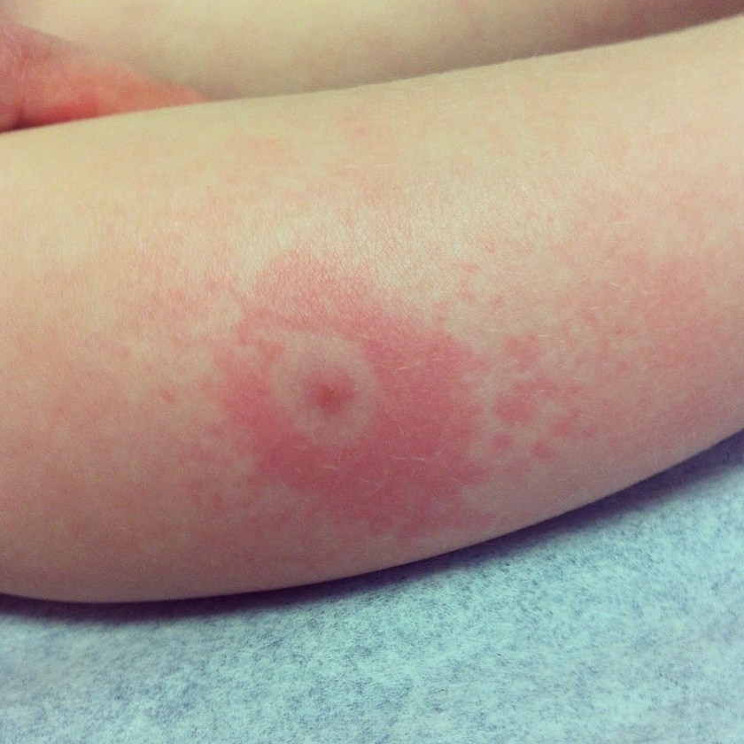 A Lyme-fertőzést jelző bőrpír