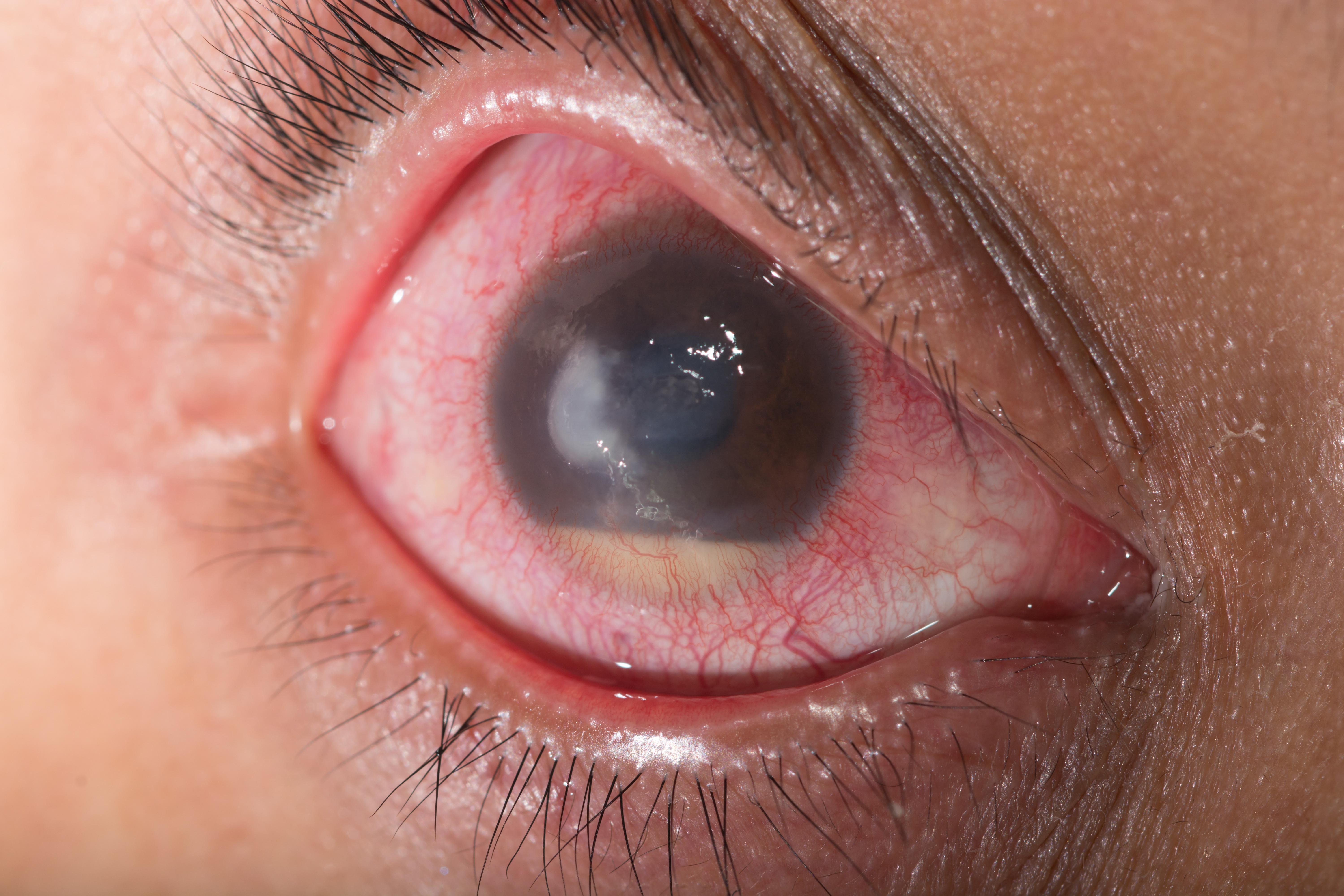 milyen szembetegségek vannak gyenge látással szültem