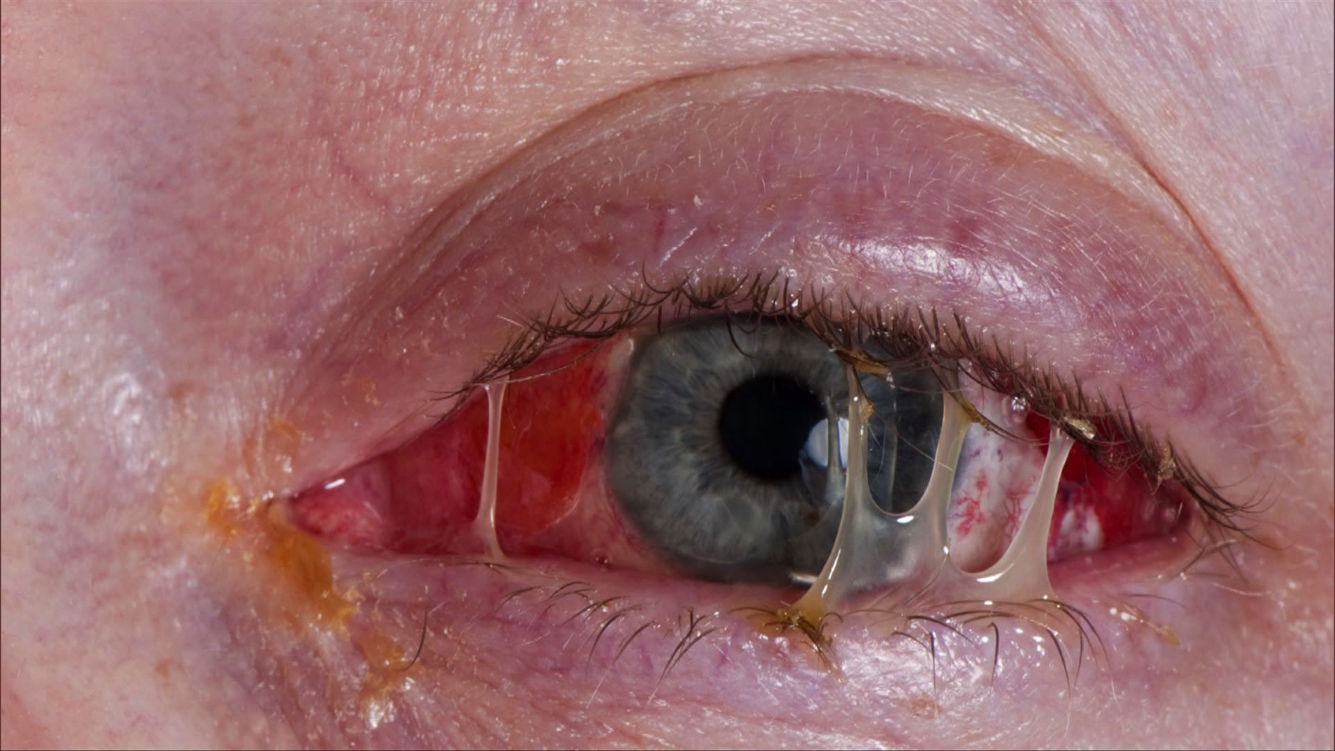 szem betegség diabetes mellitus sárgafolt duzzadási kezelés