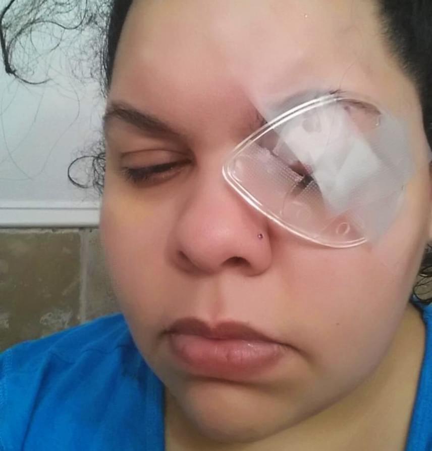 Erica Diaz egy darabka csillám miatt veszítette el a látását fél szemére, sőt, a kezelések költségei miatt komoly adóssága lett. A nő kislányával barkácsolt, amikor a csillám a szemébe került, és nem sokkal később megsértette a szaruhártyáját. Az orvosok kétszer is átültetéssel próbálkoztak, sikertelenül, míg végül - a fertőzésektől tartva - kénytelenek voltak eltávolítani Diaz szemét, aki azóta protézist visel.
                        Diaz éppen ezért óva int mindenkit attól, hogy megfelelő védelem nélkül próbálja ki a csillámos tippeket, például a sziporkázó házi manikűröket. A szem környékére készülő csillámos sminkek pedig semmilyen körülmények között sem ajánlottak.