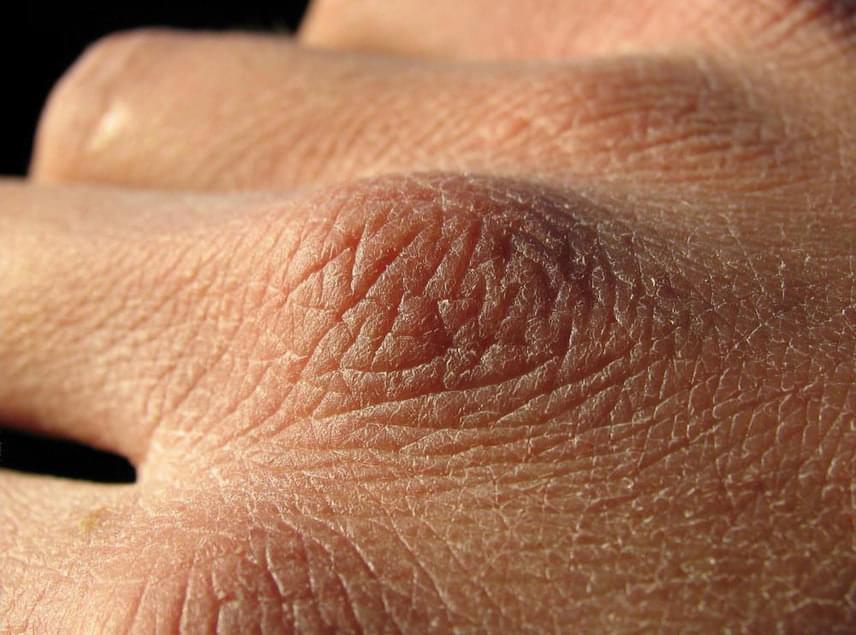 
                        	Száraz kéz
                        	A kéz száraz bőre utalhat egyszerű dehidratáltságra, amelyet bőséges folyadék bevitelével ki lehet kezelni. Természetesen erre folyamatosan azután is ügyelni kell. A kevés folyadékfogyasztás rombolja az egészséget, fáradttá és dekoncentrálttá tesz. Fontos azonban megemlíteni, hogy a száraz bőr cukorbetegség jele is lehet, melynek kapcsán ugyancsak orvosi véleményért kell folyamodni, hiszen igen komoly, szövődményekkel járó, akár életveszélyes betegségről van szó.