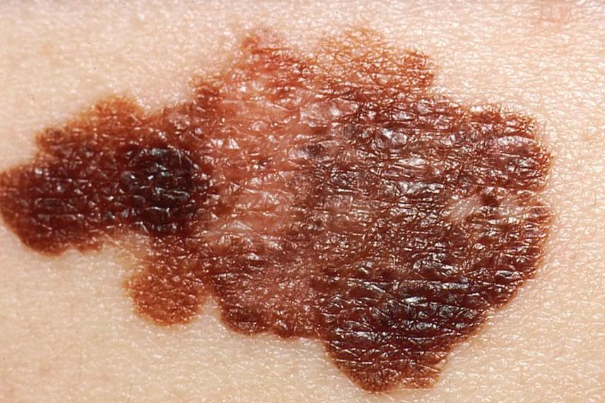 A bőrrák kialakulásának szembetűnő jelei lehetnek, nem árt azonban folyamatosan figyelni bőrödet, illetve kiszúrni a gyanús anyajegyeket, ha mielőbb szeretnéd megakadályozni a probléma súlyosbodását. A bőr pigmentsejtjeiből kialakuló, rendkívül kockázatos melanoma az ép bőrfelszínen is megjelenhet, ugyanakkor egy már meglévő anyajegyből is kiindulhat. A szabálytalan felszín és forma, az aszimmetria és a színbeli eltérések mind-mind gyanúra adhatnak okot.