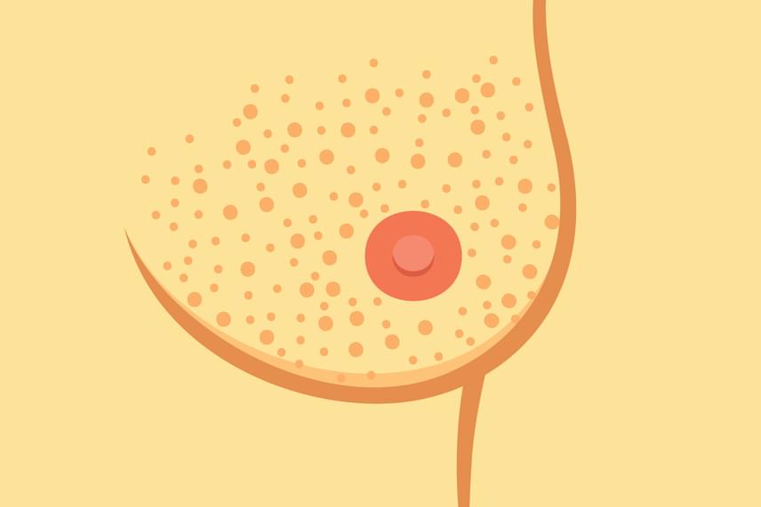 	Utóbbinak, de más mellráktípusnak is tünete lehet a mellfelszín felületének megváltozása, például érdessé vagy éppen a narancs felszínéhez hasonlóvá válása.