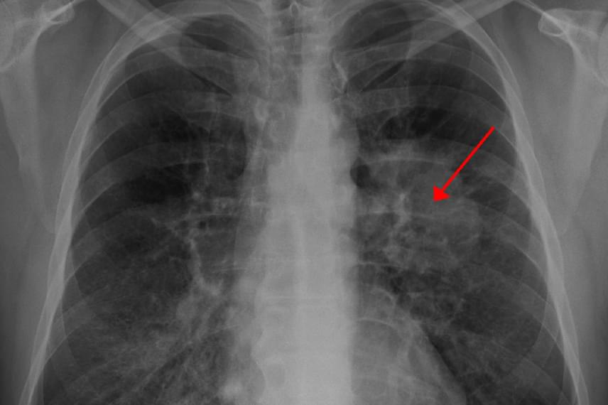 	Így néz ki a tüdő rosszindulatú elváltozása a röngtenképen, a jól látható daganatot a piros nyíl is jelöli.