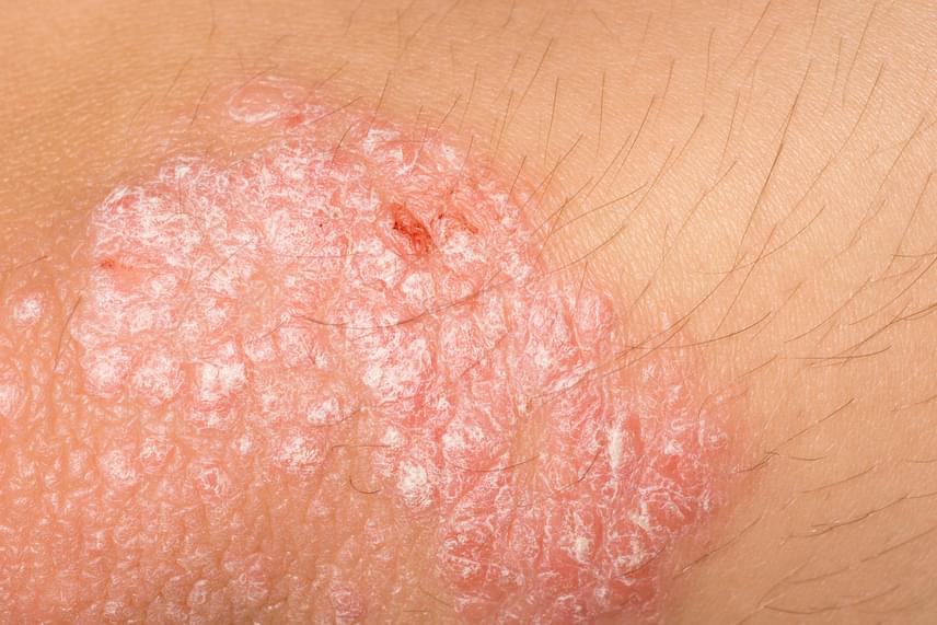 
                        	Az olyan jellegzetes bőrbetegségek, mint a pikkelysömör és a vitiligo, szintén megjelenhetnek vagy épp súlyosbodhatnak góc jelenlétének hatására. Csakúgy, mint általánosságban több autoimmun-betegség vagy a nem betegséghez köthető bőrkiütés.