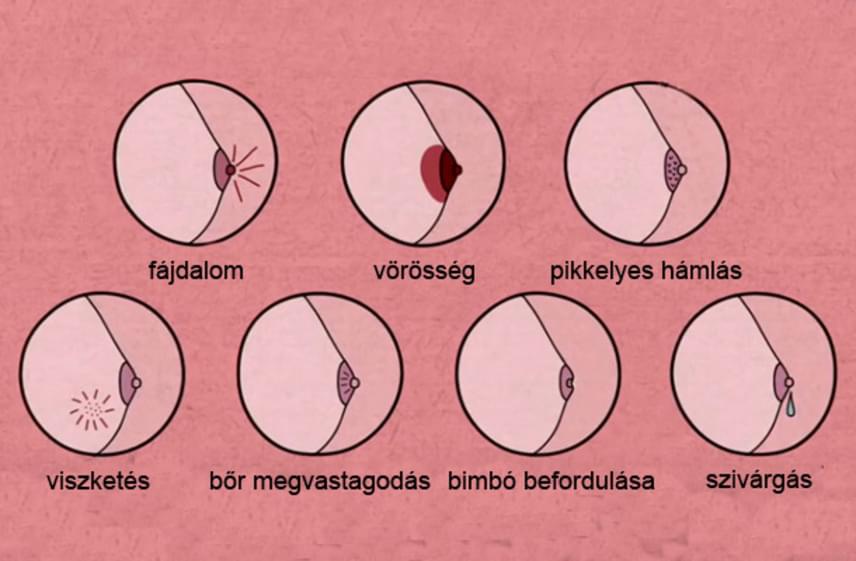 női mellbimbó rák a helmint fertőzés jelei