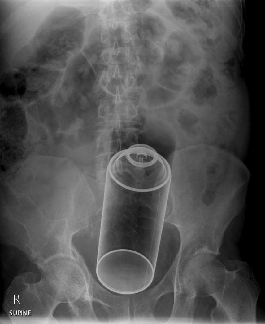	A röntgenfelvétel egy 35 éves férfi lelete. És az bizony egy hatalmas flakon dezodor.