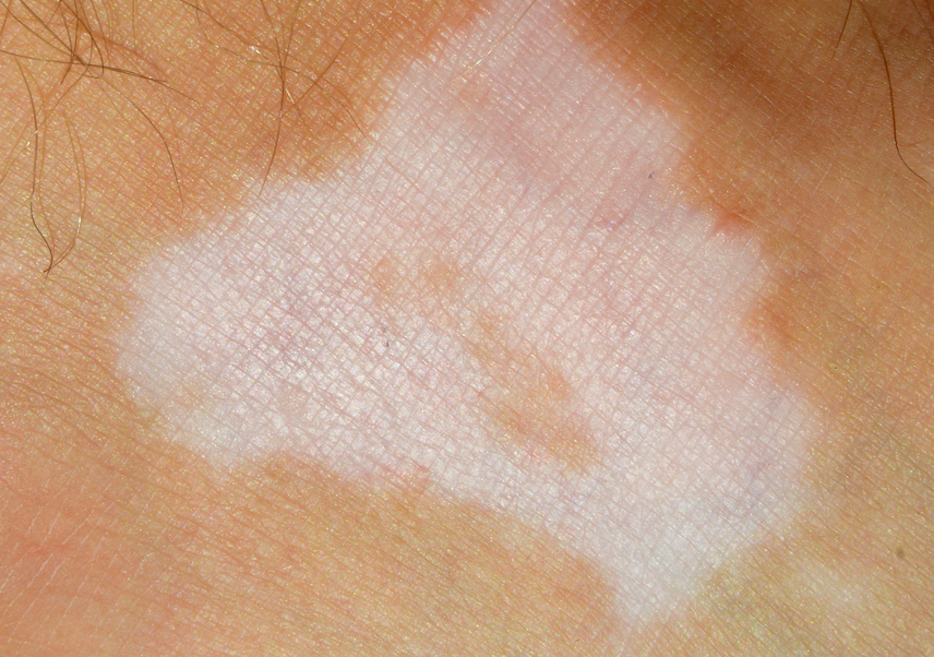 
                        	A vitiligo vagy pigmenthiány oka, hogy az immunrendszer valamilyen okból idegennek ítéli a bőr festéksejtjeit, a melanocitákat, és elpusztítja azokat. Magyarországon jelenleg is körülbelül száz-kétszázezer vitiligós beteg él - jellemző lehet már gyermekkorban is -, nagyobb volumenű kutatása azonban még várat magára.