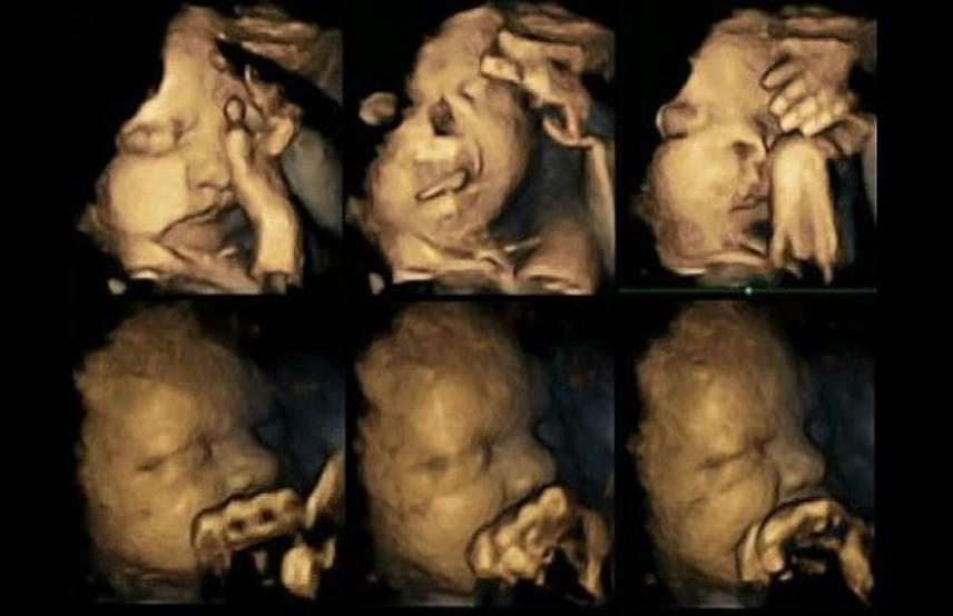 
                        	A felső képeken egy rágyújtó kismama méhében ultrahangozott babát, alul pedig egy nemdohányzó kismama ultrahangját láthatod.
                        	A megfigyeléseket 24, 28, 32 és 36 hetes terhes kismamák részvételével végezték. Arra jutottak, hogy a dohányzás perceiben a baba gyakrabban mozgatja a száját és gyakrabban érinti meg az arcát, mint a nemdohányzó anyák babái.