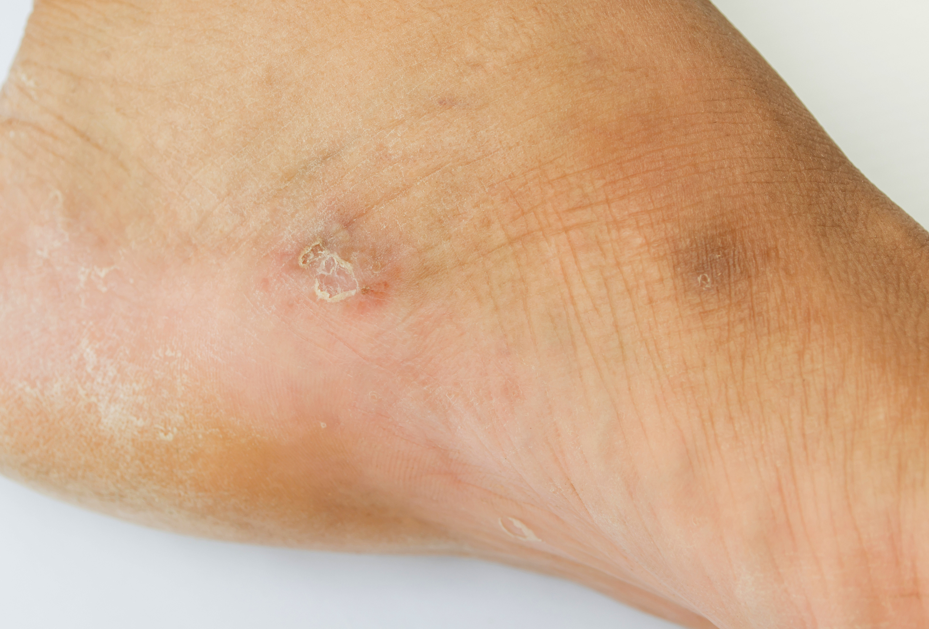 Láb- és körömgomba tünetei és kezelése - HáziPatika - A lábujjakon lévő piros foltok gombák