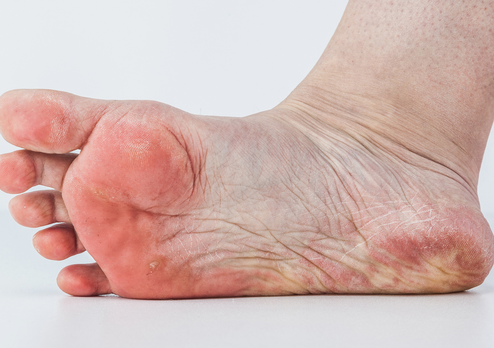 Gomba lábujjak között tünetei, kezelése a különböző azt jelenti,