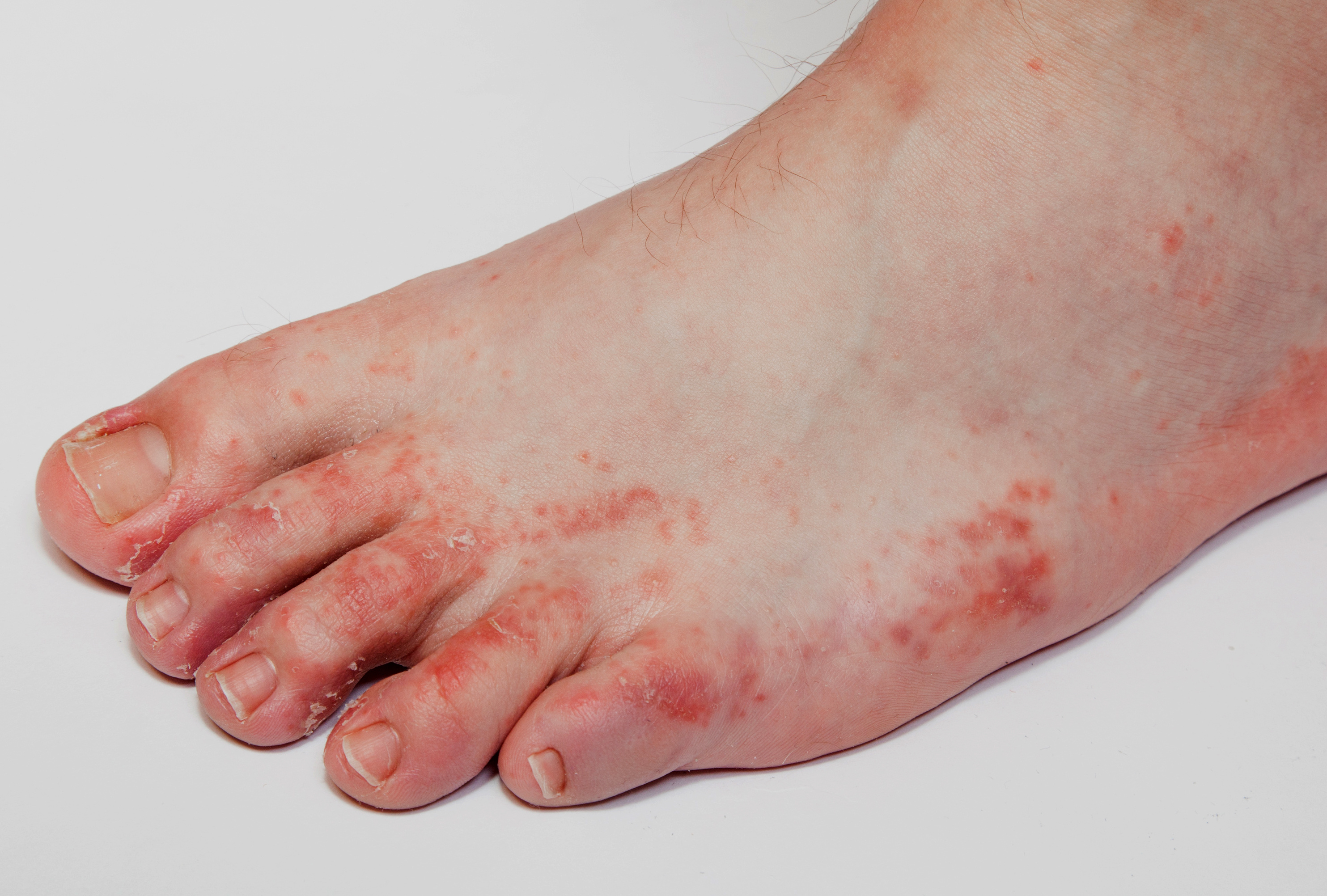 hólyagok a lábujjak között tsepnem fertőzés