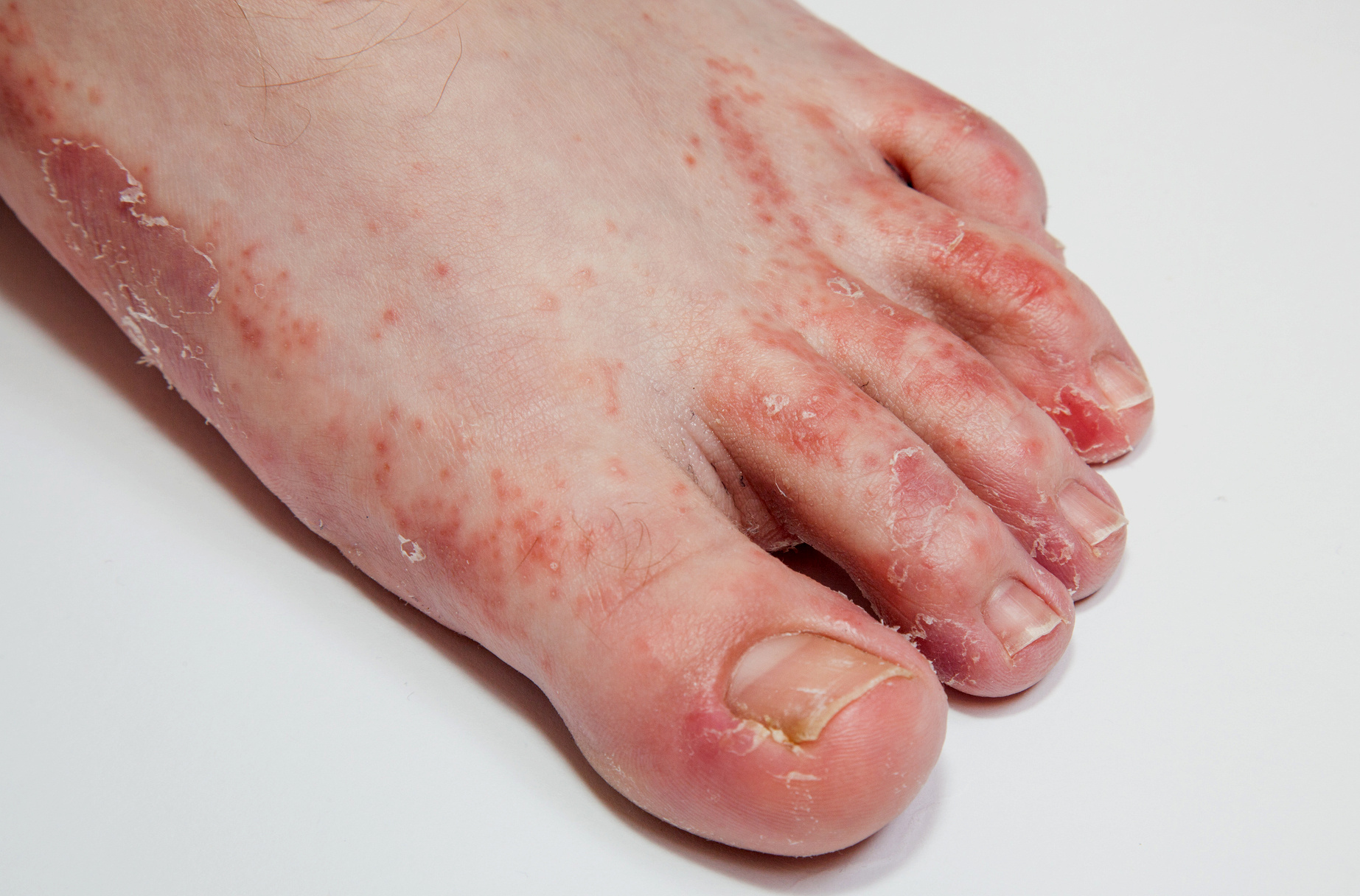 a lábujjakon lévő piros foltok gombák hatékony orvosság az arcon lévő vörös foltok ellen