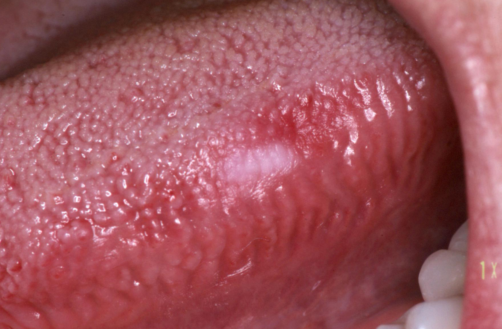 Papilloma vírus szájpadlás