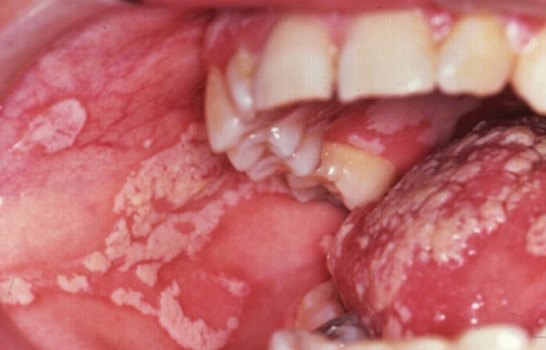 Humán papillomavírus - Szemölcsök a száj nyálkahártyáján