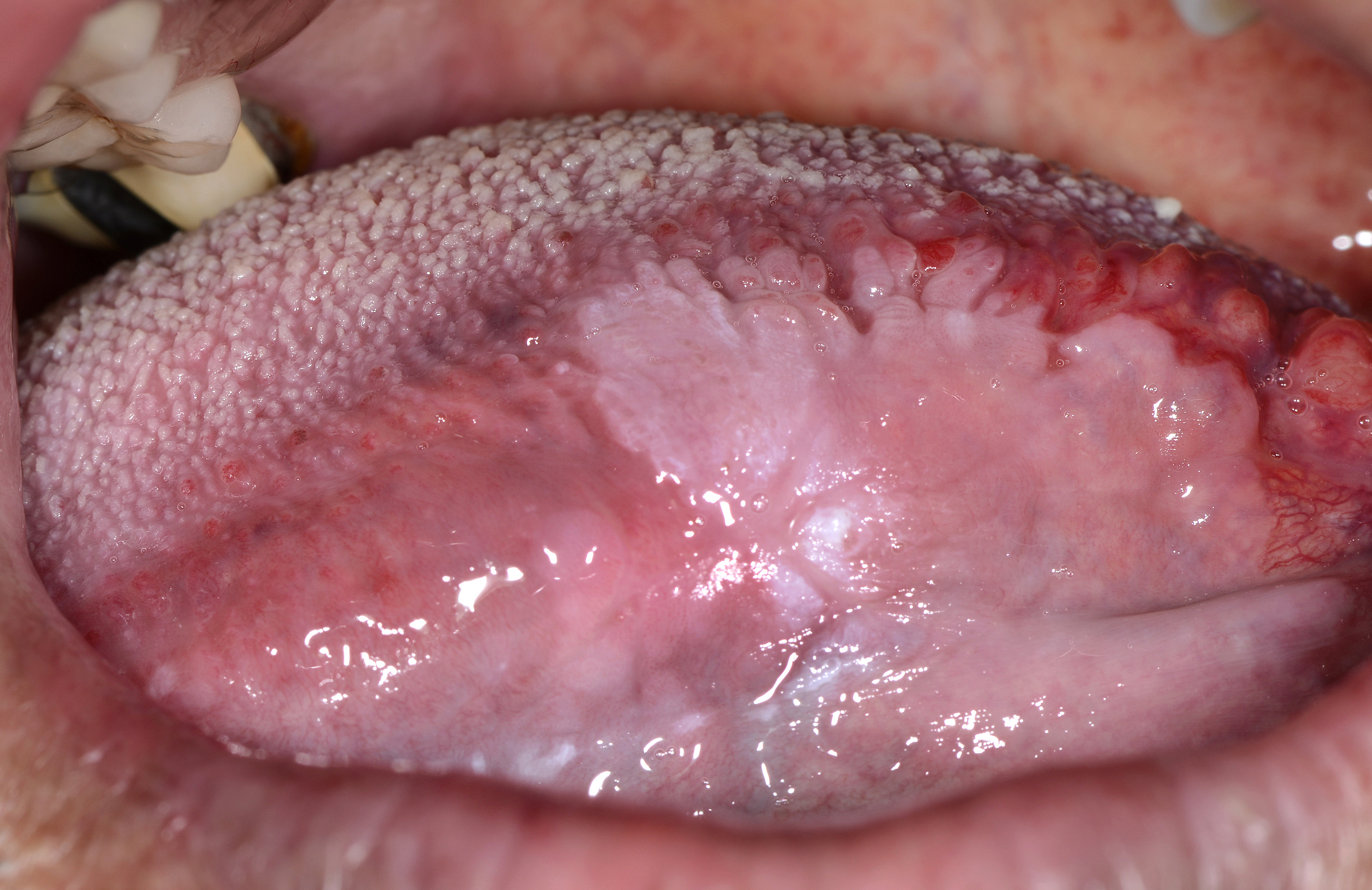 HPV-szemölcs az ínyen? - Fog- és szájbetegségek