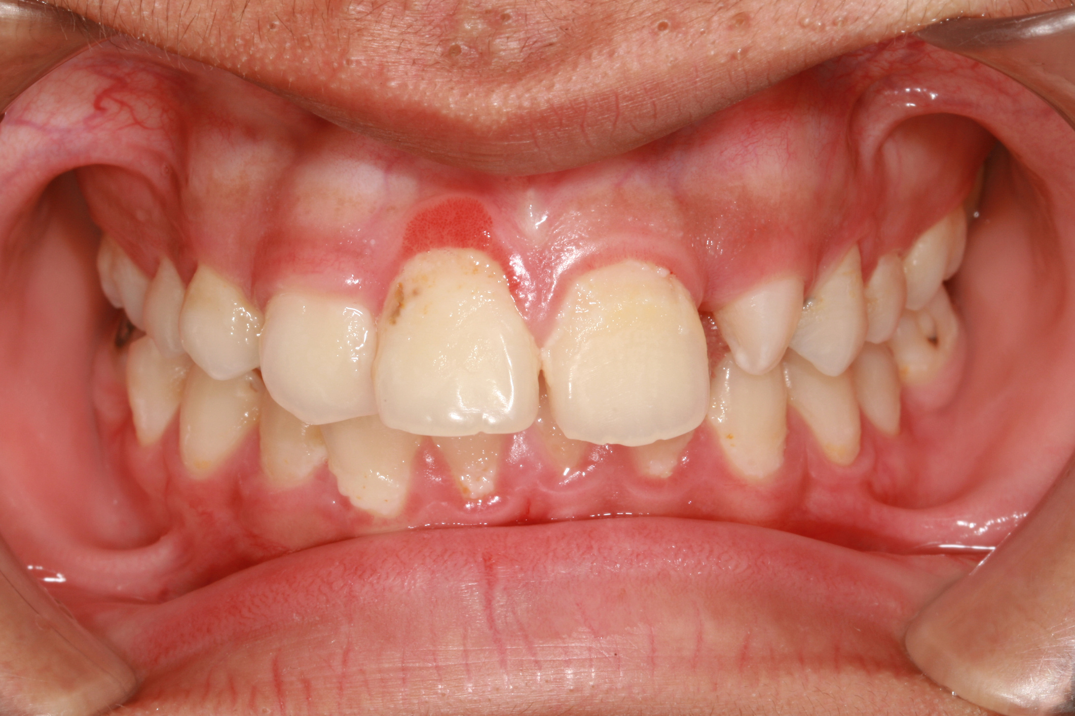 vörös szájfoltok a szájban a felnőttek kezelésében