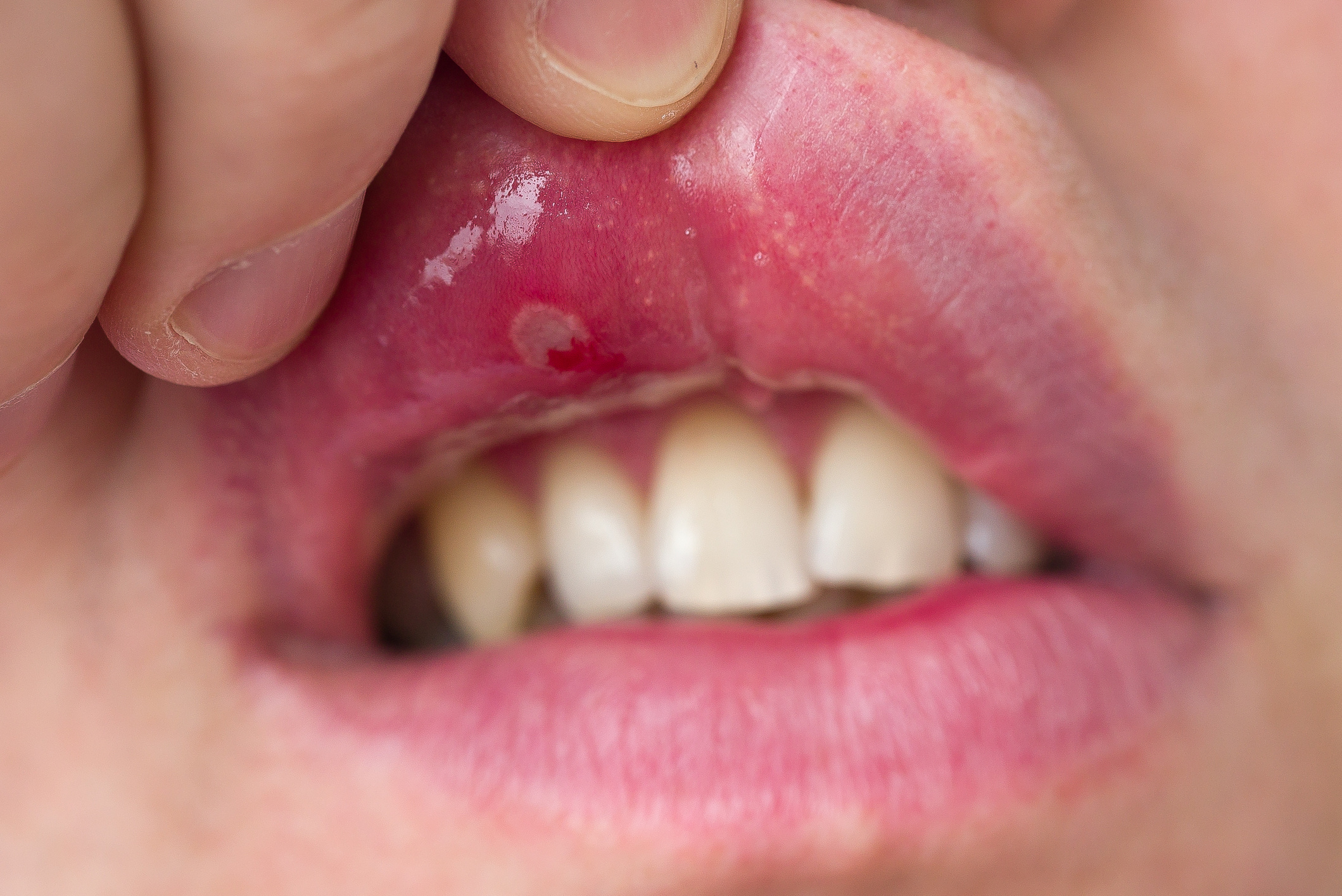 Fogyás fekély száj, Rák jele a szájban - Egészség | Femina