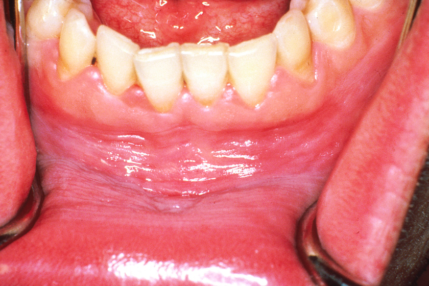 Az alsó ajkak szokatlan barázdáltsága és elfehéredése a leukoplákia tünete lehet, ami a szájnyálkahártyán jelentkező rákmegelőző állapot.