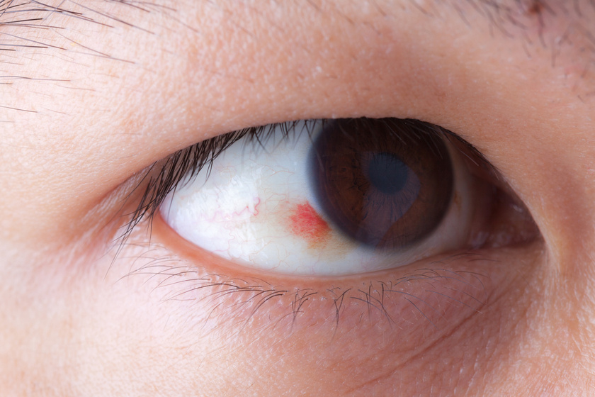 a szem vörös foltja okozza a kezelés módját
