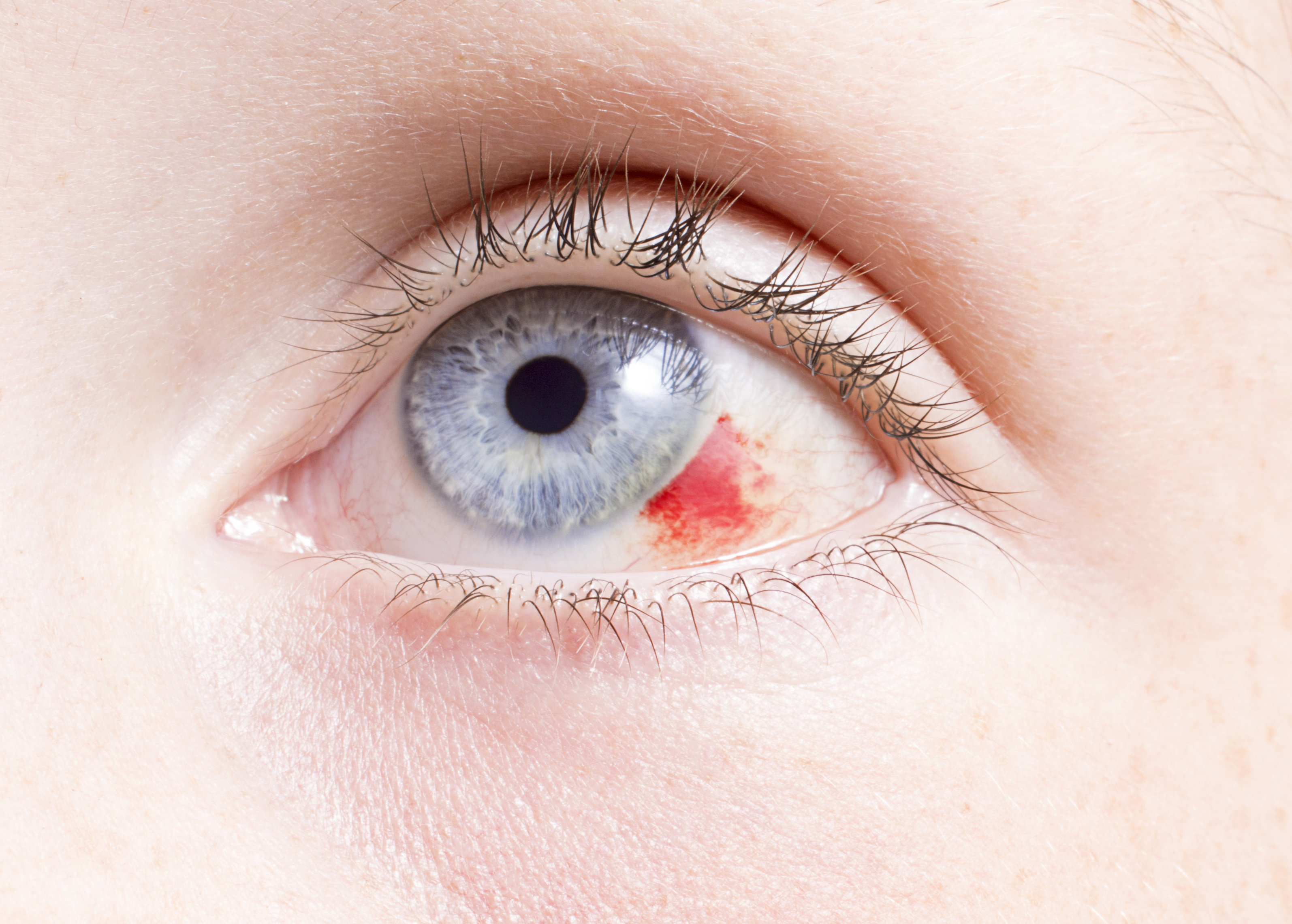 Ritka, de agresszív daganat a szem melanomája – Semmelweis Médiasarok