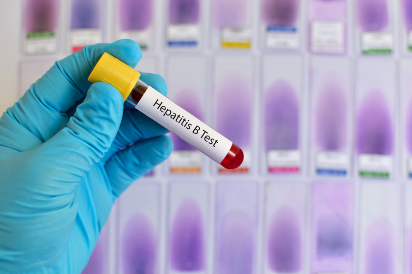 Visszértágulat hepatitis C-vel. A hepatitis C-t új protokollokkal kezelik