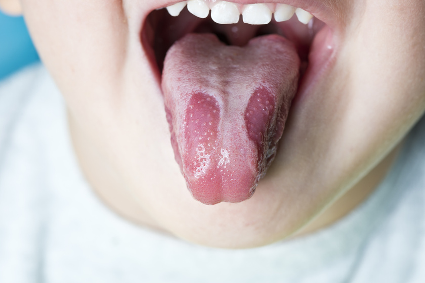 nyelv vörös foltokban egy felnőtt kezelés során)