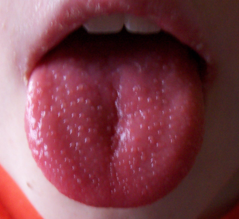 papilláris elváltozás a nyelv alatt