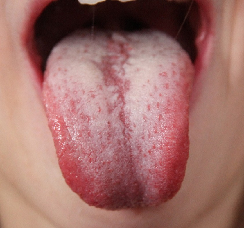 nyelv papillae fájdalom hpv vírus a porod