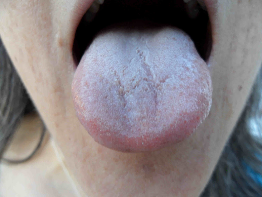 A nyelv lepedékessége egy határig természetes, de a fehér réteg feltűnő megvastagodása emésztőrendszeri problémákra, gyulladásra vagy bakteriális fertőzésre is utalhat.