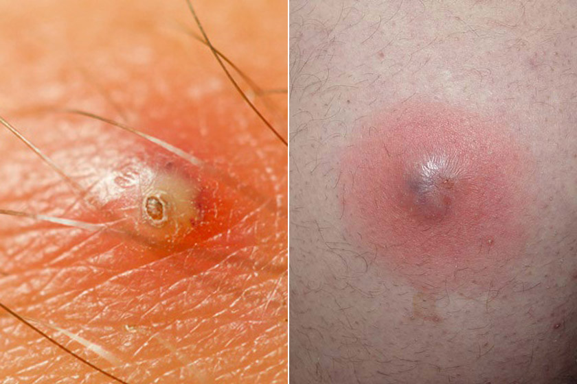 cerave psoriasis cleanser target hatalmas vörös foltok a bőrön