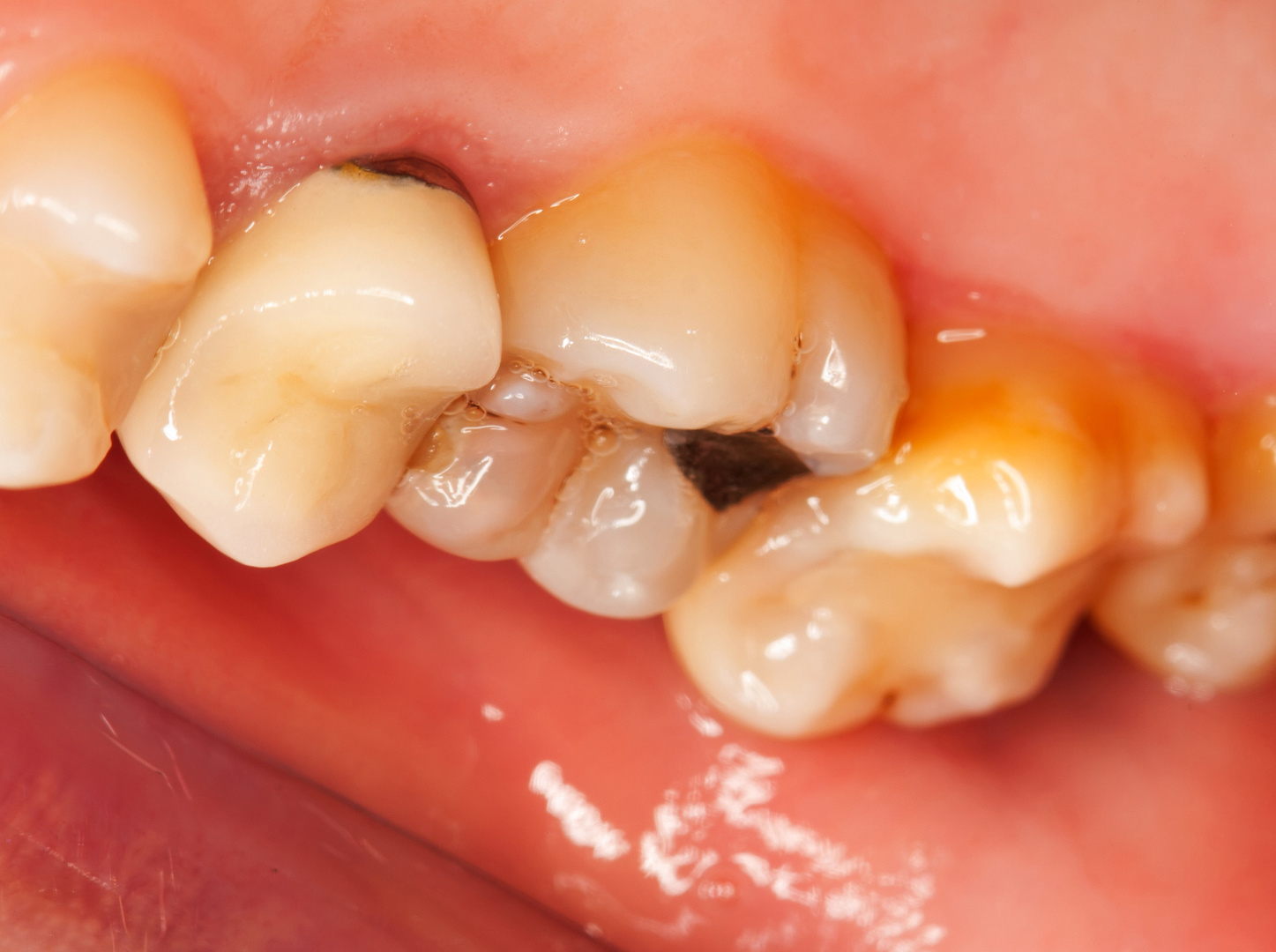 A fogszuvasodás és a fogak romlásának tünetei, okai és kezelése
