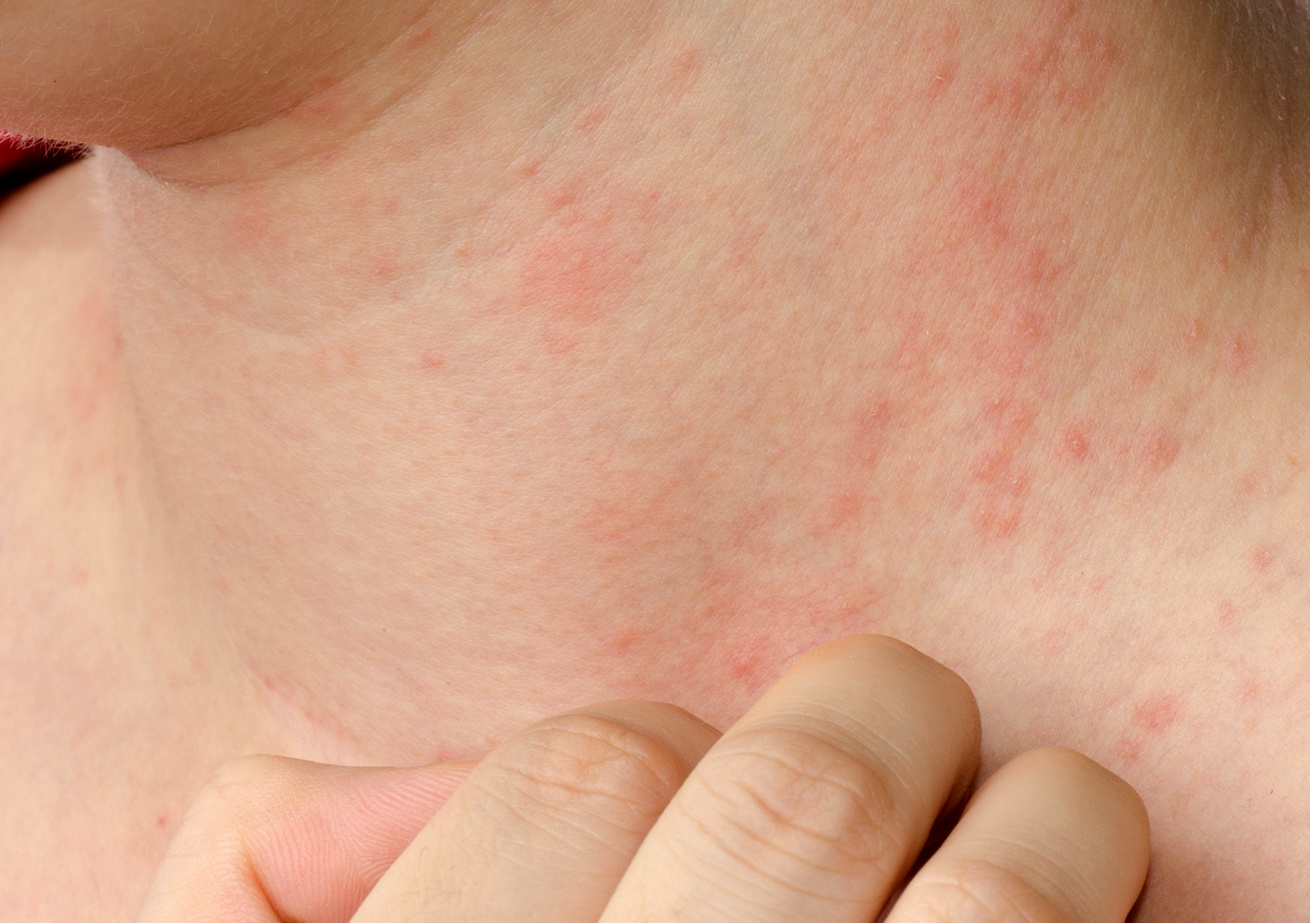 Milyen betegségekhez társulhat a bőrgomba?