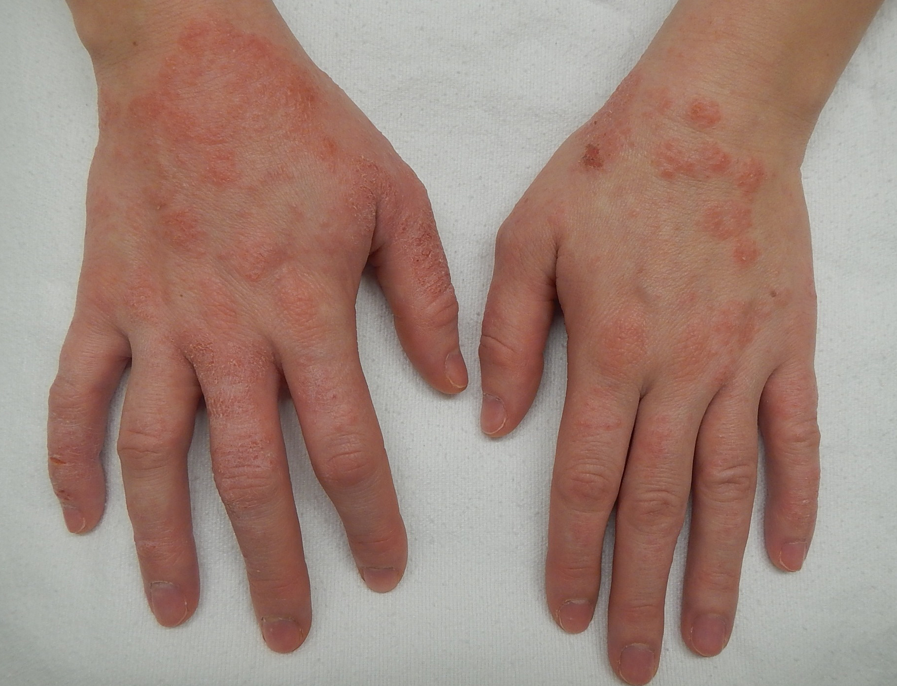 Pöttyös tenyerek, pöttyös talpak: a kéz-láb-száj betegség