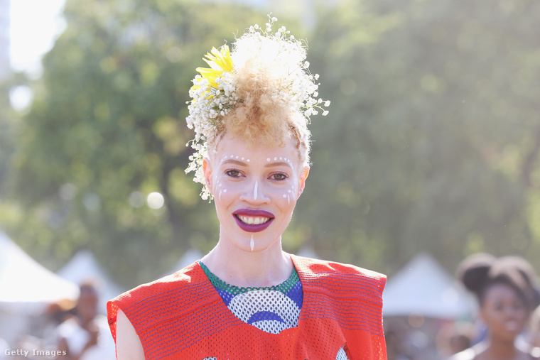 Diana Forrest afro-amerikai modell, és ez azért nem látszik rajta, mert albinizmussal született, ami a haj, a bőr és a szemek pigmenthiányát jelenti