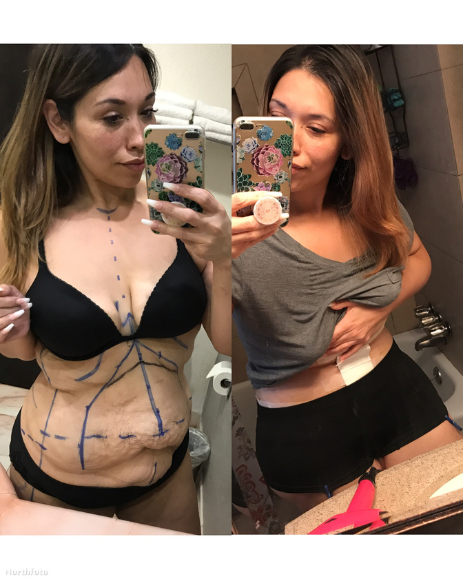 Operáció előtt és után.
